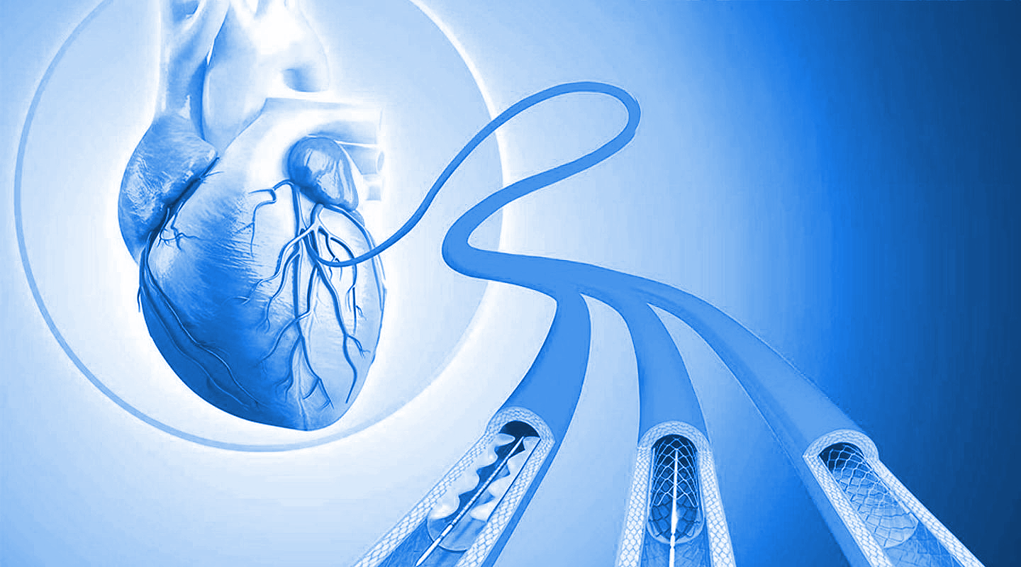 Angiografi & Angioplasti Koroner