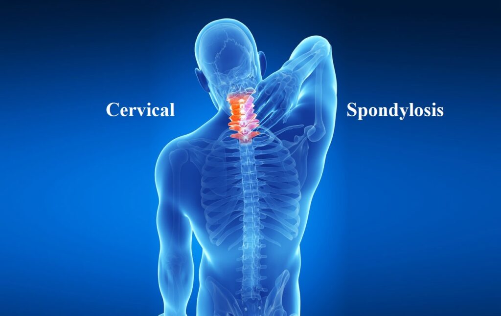 cervical-spondylosis-nyeri-leher